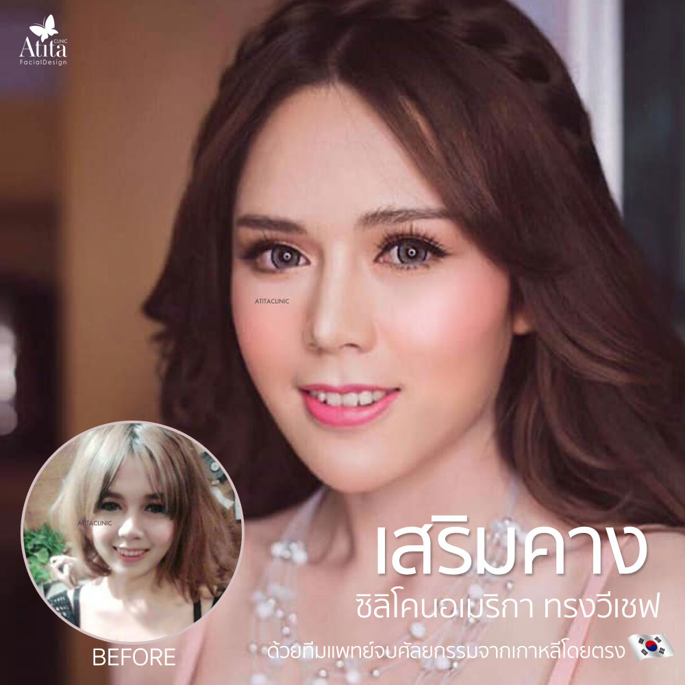 ศัลยกรรมเสริมคาง คืออะไร? เสริมคางราคาเท่าไร? - Atita Clinic