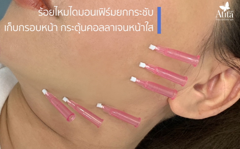 ร้อยไหมไดมอน