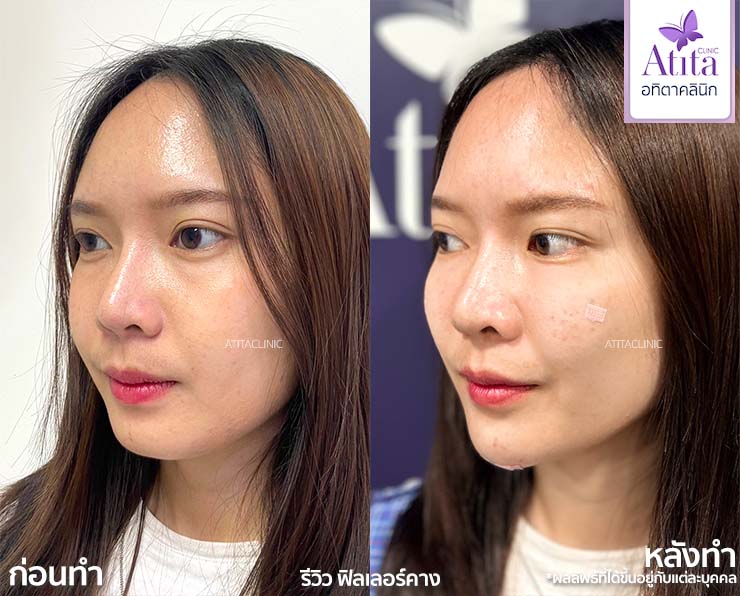 รีวิวฟิลเลอร์คาง Fillerคาง เสริมคาง คางสั้น ฟิลเลอร์ของแท้ อทิตาคลินิก Atitaclinic หมอนุ่น