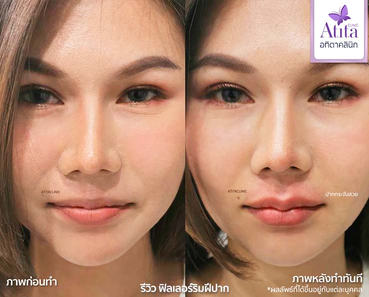 รีวิวฟิลเลอร์ปาก ฟิลเลอร์ปาก fillerปาก ปากทรงสายฝ ปากทรงเกาหลี ฟิลเลอร์ของแท้ อทิตาคลินิก atitaclinic