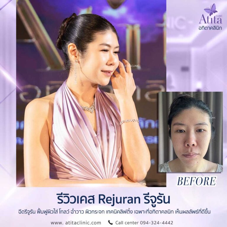 Rejuran ช่วยให้ผิวใส ลดขนาดรูขุมขนได้อย่างไร เหมาะกับใคร กี่วันเห็นผล