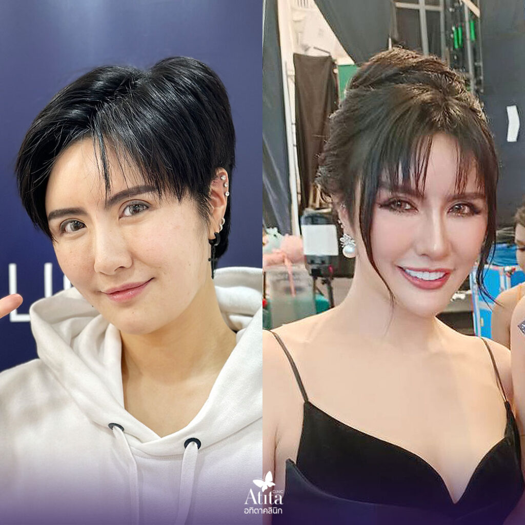 ฉีดโบท็อก คืออะไร ? botox เห็นผลคุ้มค่าหรือไม่ ? มีข้อควรรู้อะไรบ้างก่อนตัดสินใจฉีด ? โบท็อกซ์ ราคา โปรโบท็อกซ์