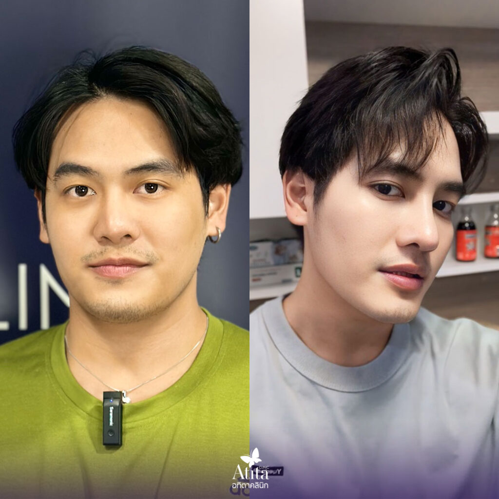 ฉีดโบท็อก คืออะไร ? botox เห็นผลคุ้มค่าหรือไม่ ? มีข้อควรรู้อะไรบ้างก่อนตัดสินใจฉีด ? โบท็อกซ์ ราคา โปรโบท็อกซ์