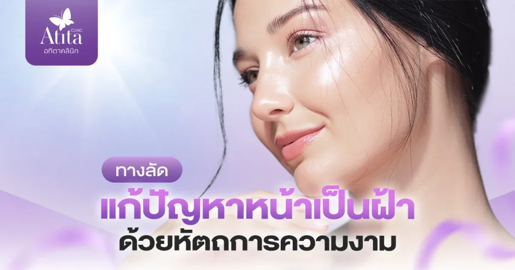 ทางลัดแก้ปัญหาหน้าเป็นฝ้า ด้วยหัตถการความงาม