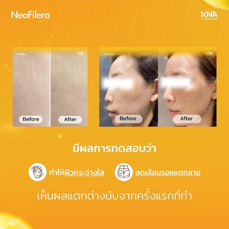 Neofilera ไหมน้ำ คลินิก อทิตาคลินิก คลินิกไหมน้ำกรุงเทพ ฉีดไหมน้ำ