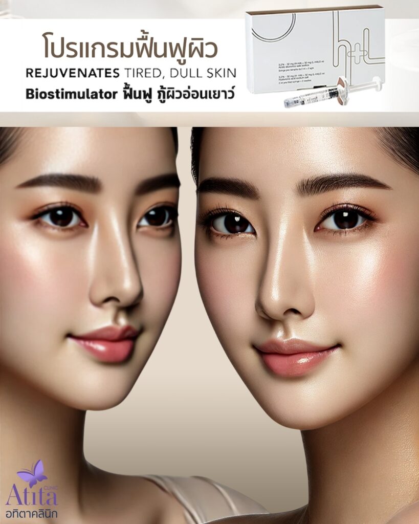 Profhilo โปรไฟโล ของแท้ อทิตาคลินิก คลินิกกรุงเทพ Atitaclinic ไหมน้ำ คอลลาเจน