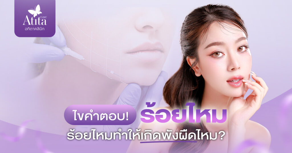 ไขคำตอบ! ร้อยไหมทำให้เกิดพังผืดไหม?