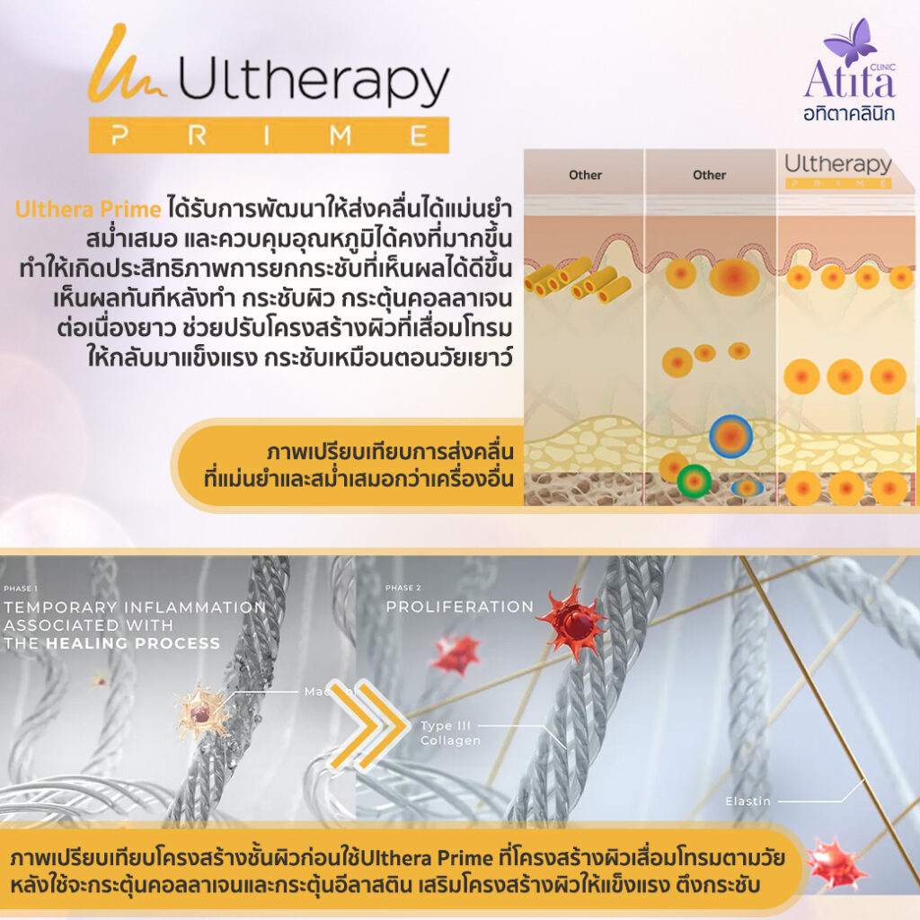 Ultheraprimeของแท้ Ultheraรุ่นใหม่ ยกกระชับหน้า อทิตาคลินิก