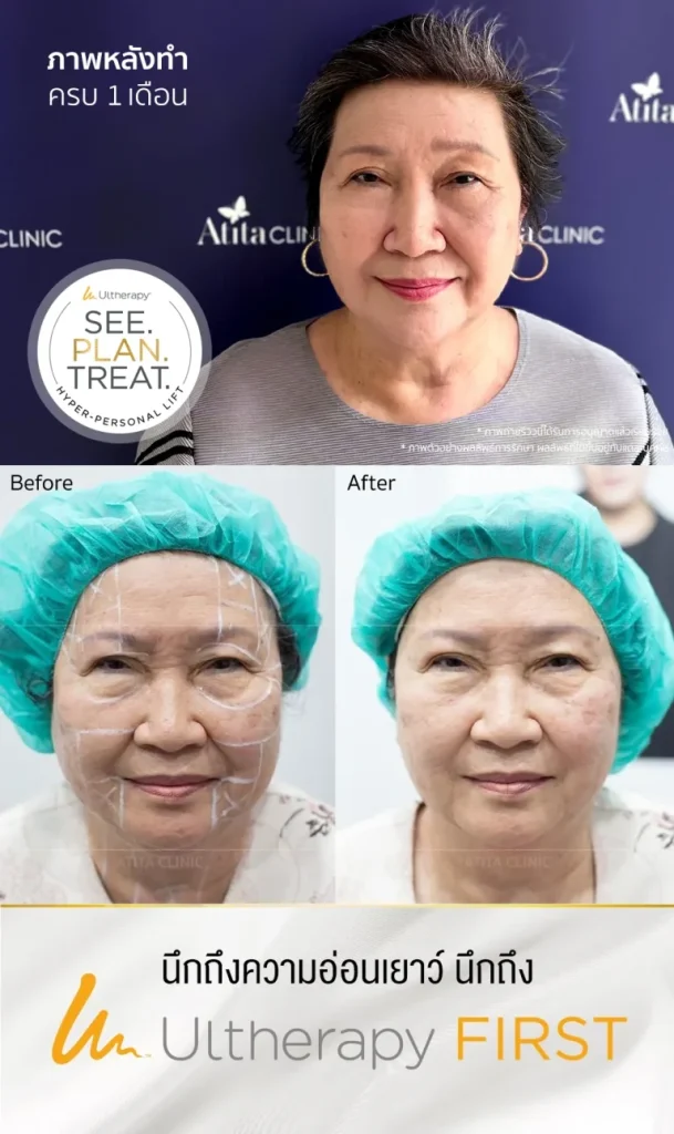 รีวิวผลลัพธ์หลังการทำ Ulthera ที่ Atita Clinic ผู้หญิง