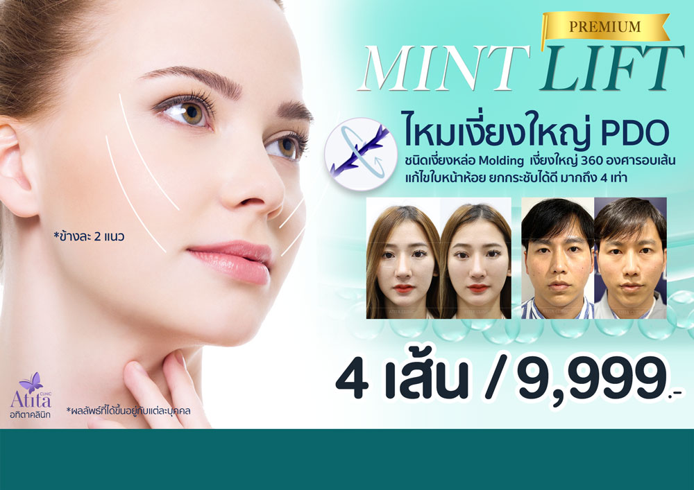 รีวิว-ร้อยไหม-ปรับรูปหน้ายกกระชับ-ใช้ไหมกี่เส้น-เห็นผลแค่ไหน-ไหมมิ้นต์-ไหม-Mint