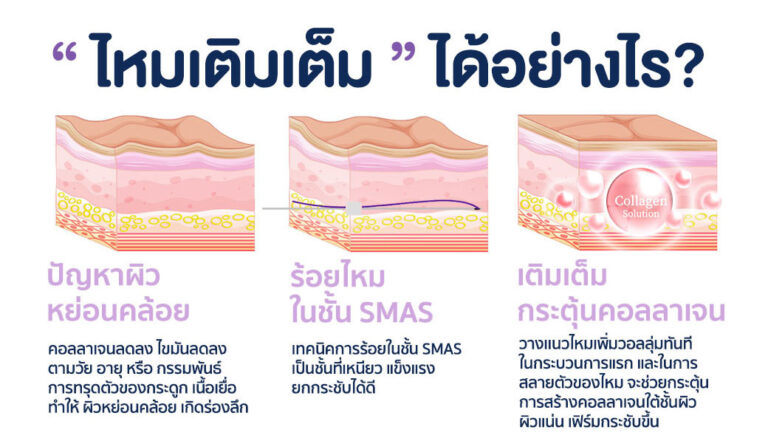 ไหมโครงตาข่าย Mesh Volumizeคือ ราคาเท่าไหร่ ต่างจากไหมก้างปลาแบบอื่นอย่างไร