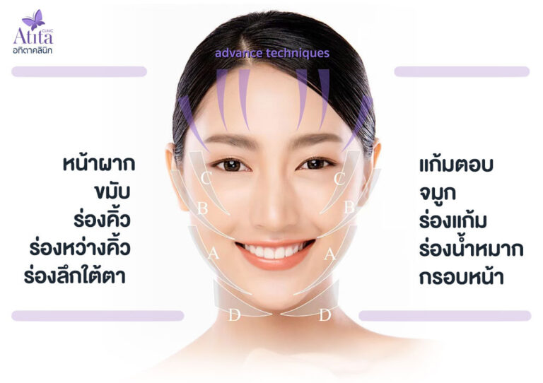 ไหมโครงตาข่าย คือ ราคาเท่าไหร่ ต่างจากไหมก้างปลาแบบอื่นอย่างไร