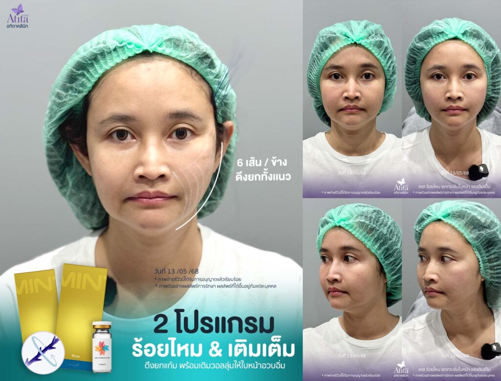 combine---mint-+-ultracol