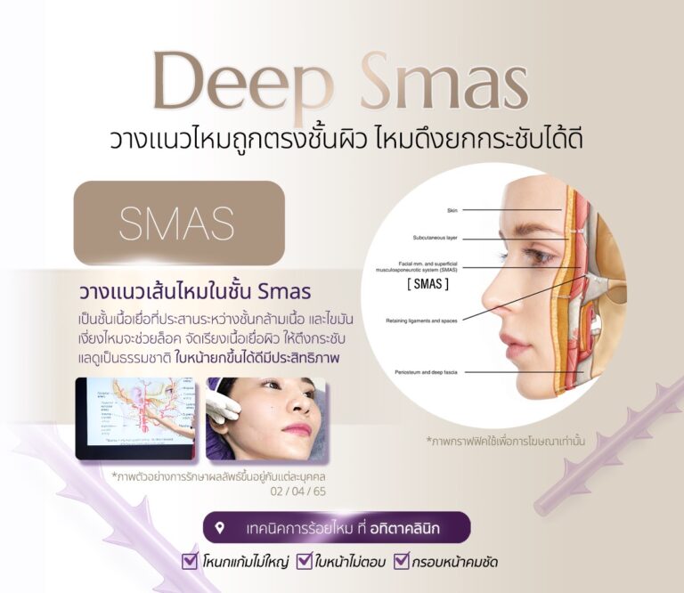 ร้อยไหม-ร้อยไหมดีไหม-ร้อยไหมที่ไหนดี-หมอเก่งร้อยไหม-ร้อยไหมอิตาลี