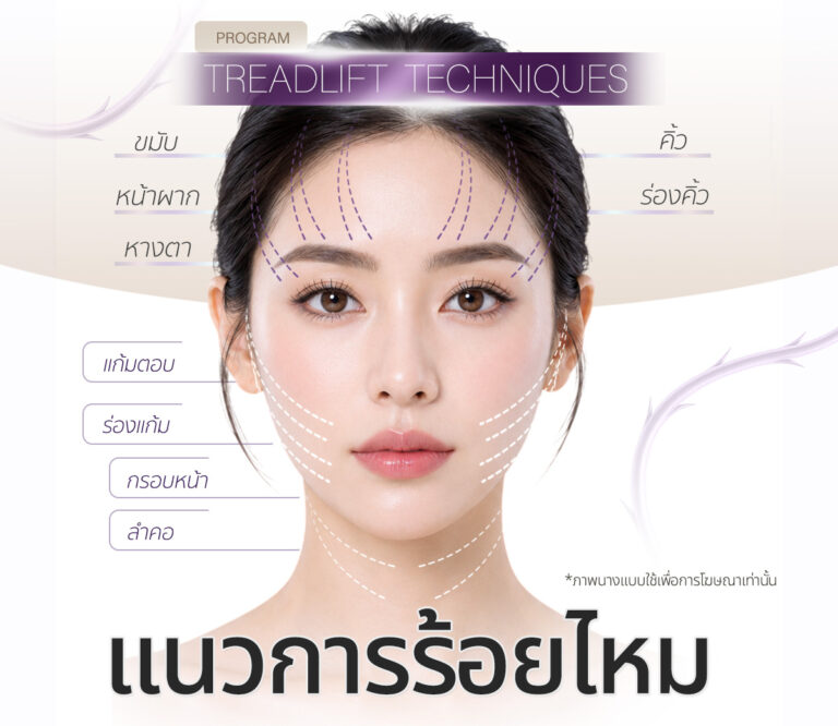 ร้อยไหมหน้า ทำตำแหน่งไหนของใบหน้า ช่วยอะไรบ้าง Atita Clinic